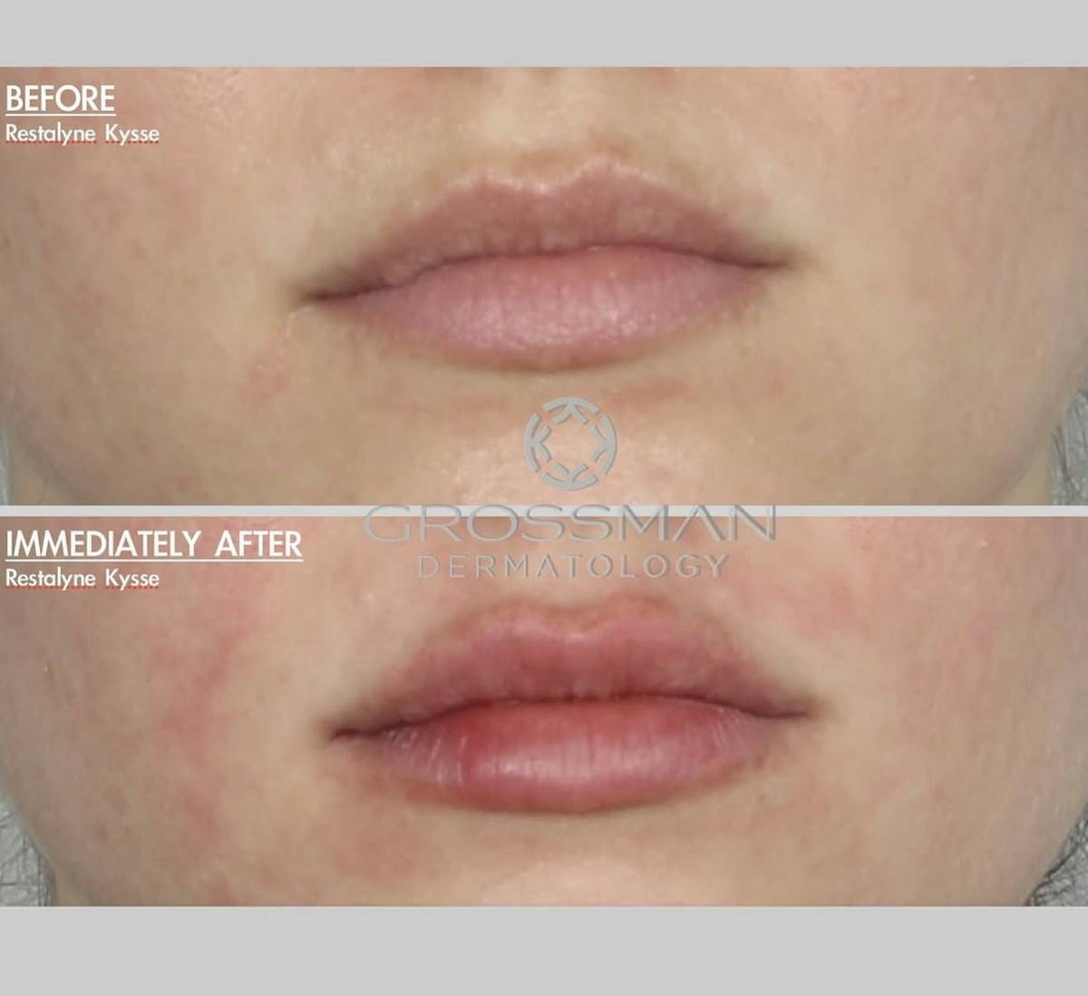 Lips Before & After Gallery - Patient 405061 - Image 1