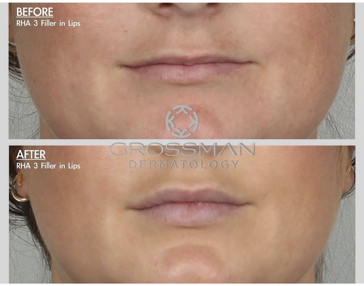 Lips Before & After Gallery - Patient 217736 - Image 1