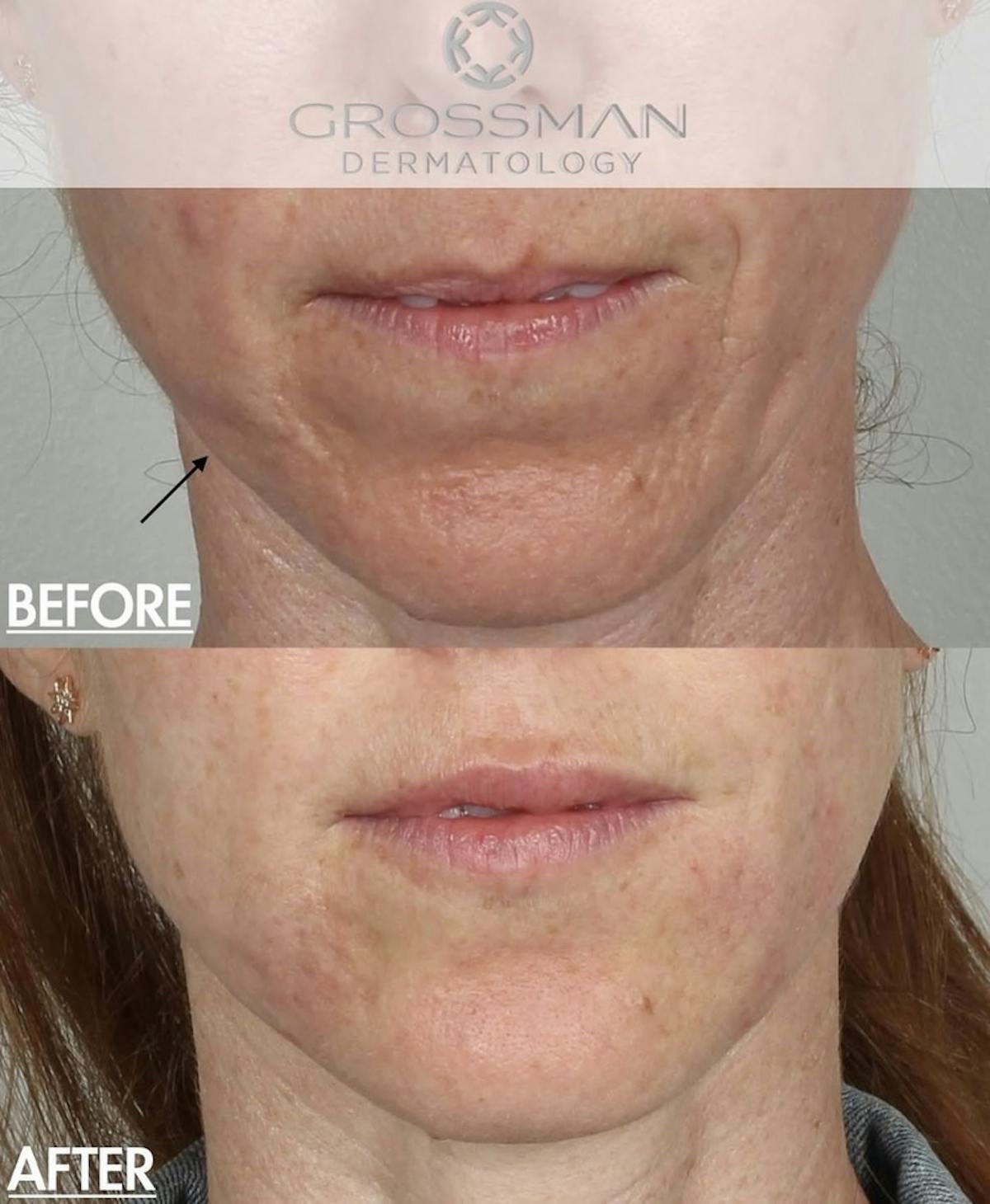 Lower Face Before & After Gallery - Patient 328060 - Image 1