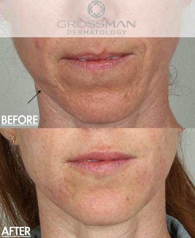 Lower Face Before & After Gallery - Patient 328060 - Image 1