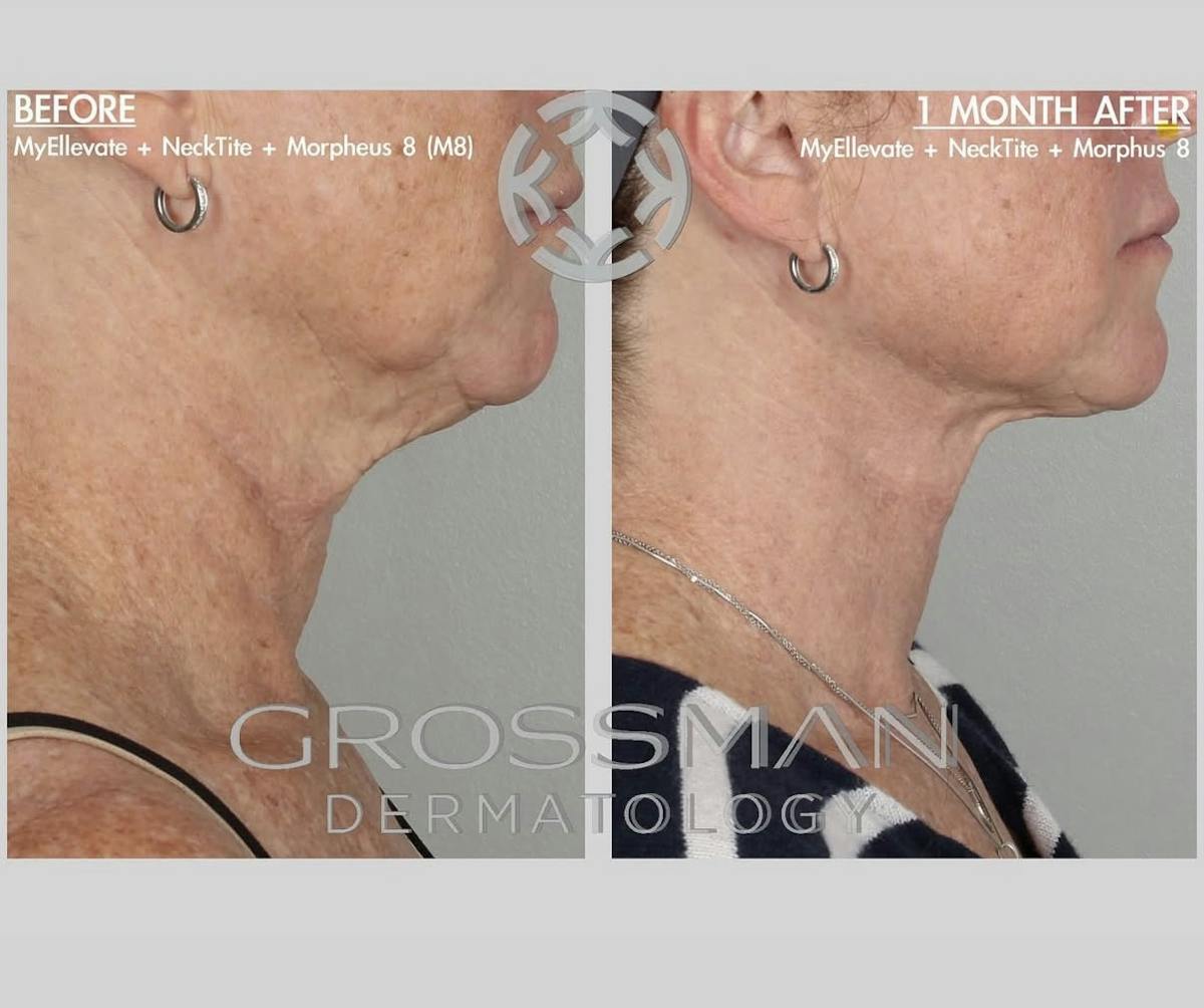 FaceTite & NeckTite Before & After Gallery - Patient 250461 - Image 1