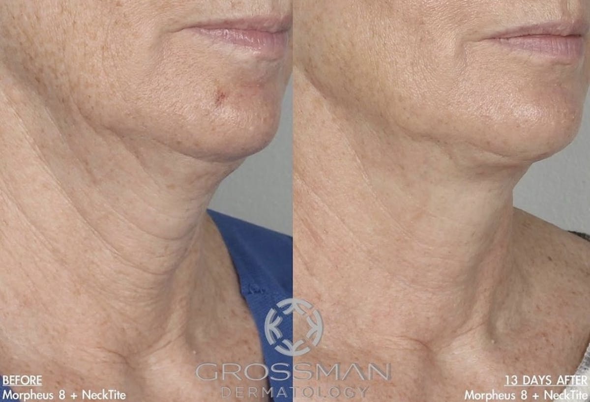 M8 Before & After Gallery - Patient 199099 - Image 1