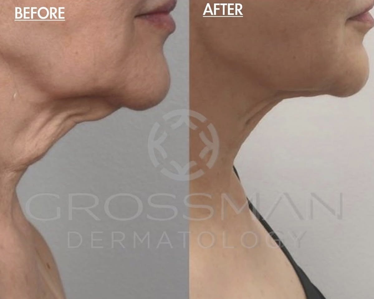 FaceTite & NeckTite Before & After Gallery - Patient 396503 - Image 1