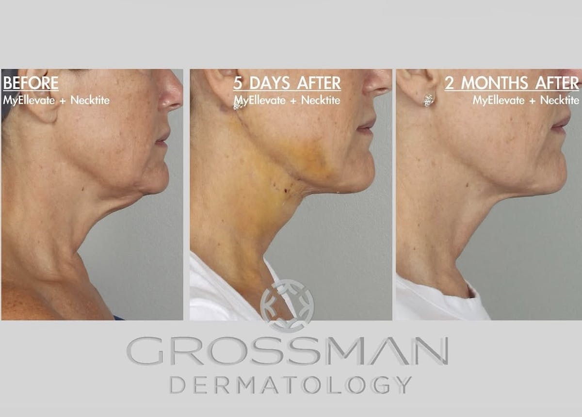 MyEllevate Before & After Gallery - Patient 322093 - Image 1