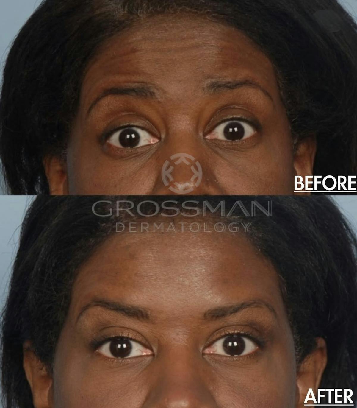 Botox & Neuromodulators Before & After Gallery - Patient 417029 - Image 1