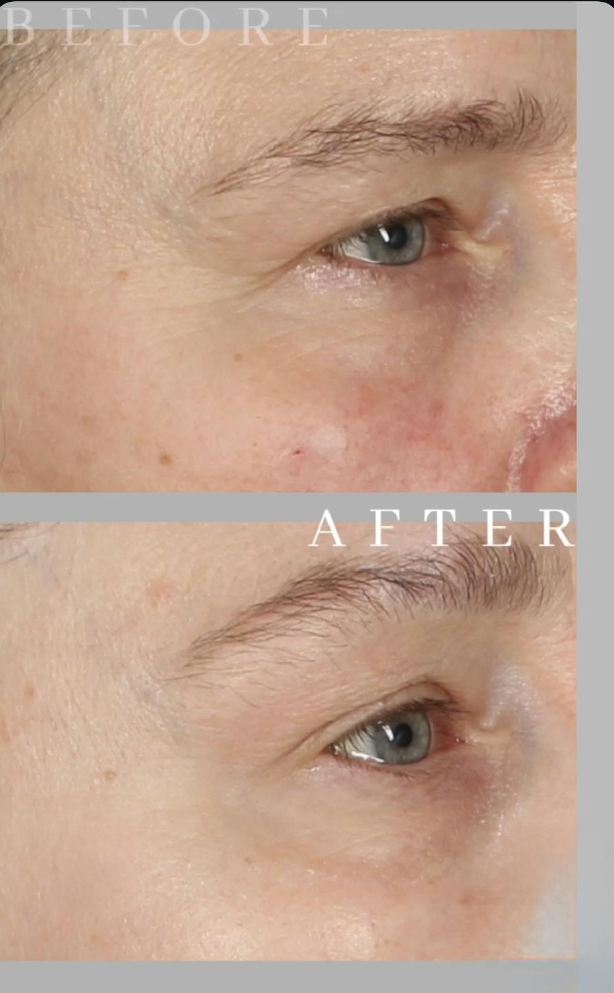 Botox & Neuromodulators Before & After Gallery - Patient 358698 - Image 1