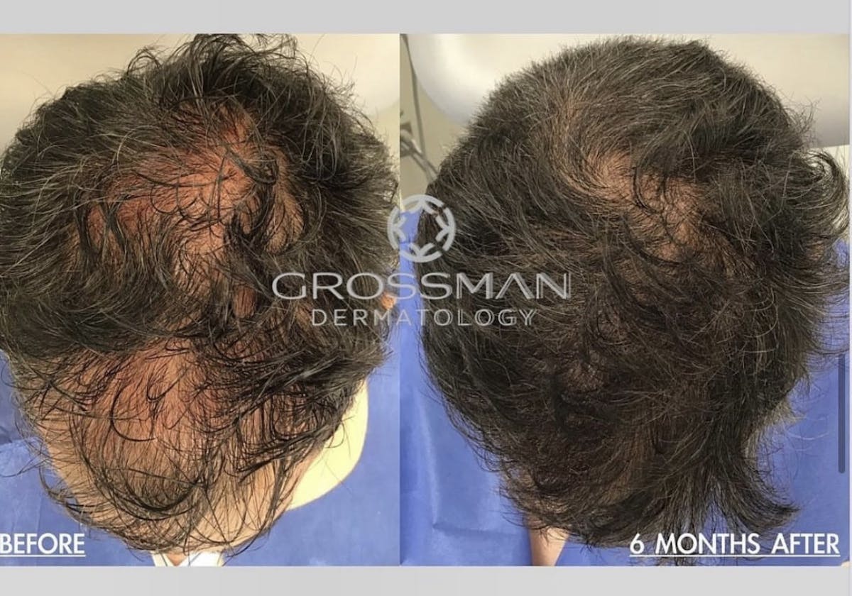 PRP Before & After Gallery - Patient 269166 - Image 1