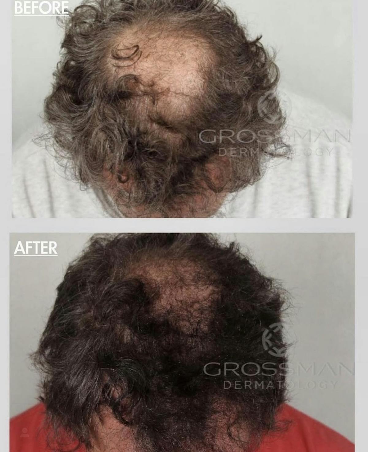 PRP Before & After Gallery - Patient 356671 - Image 1