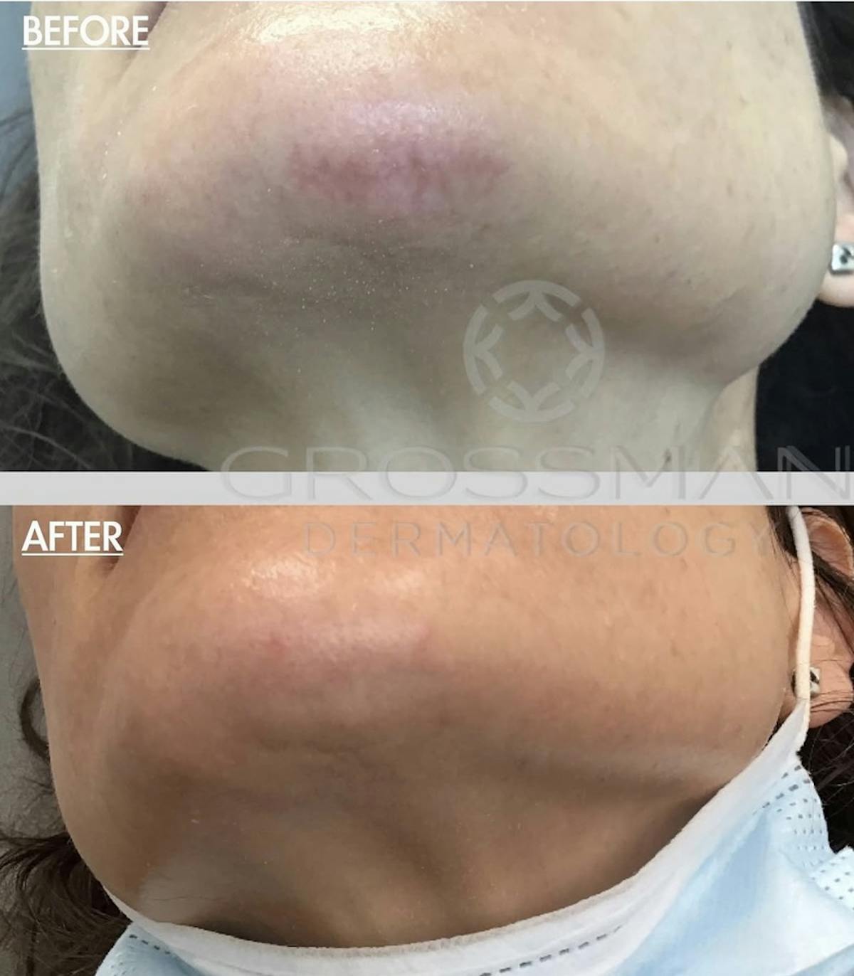 Scar Revision Before & After Gallery - Patient 279571 - Image 1