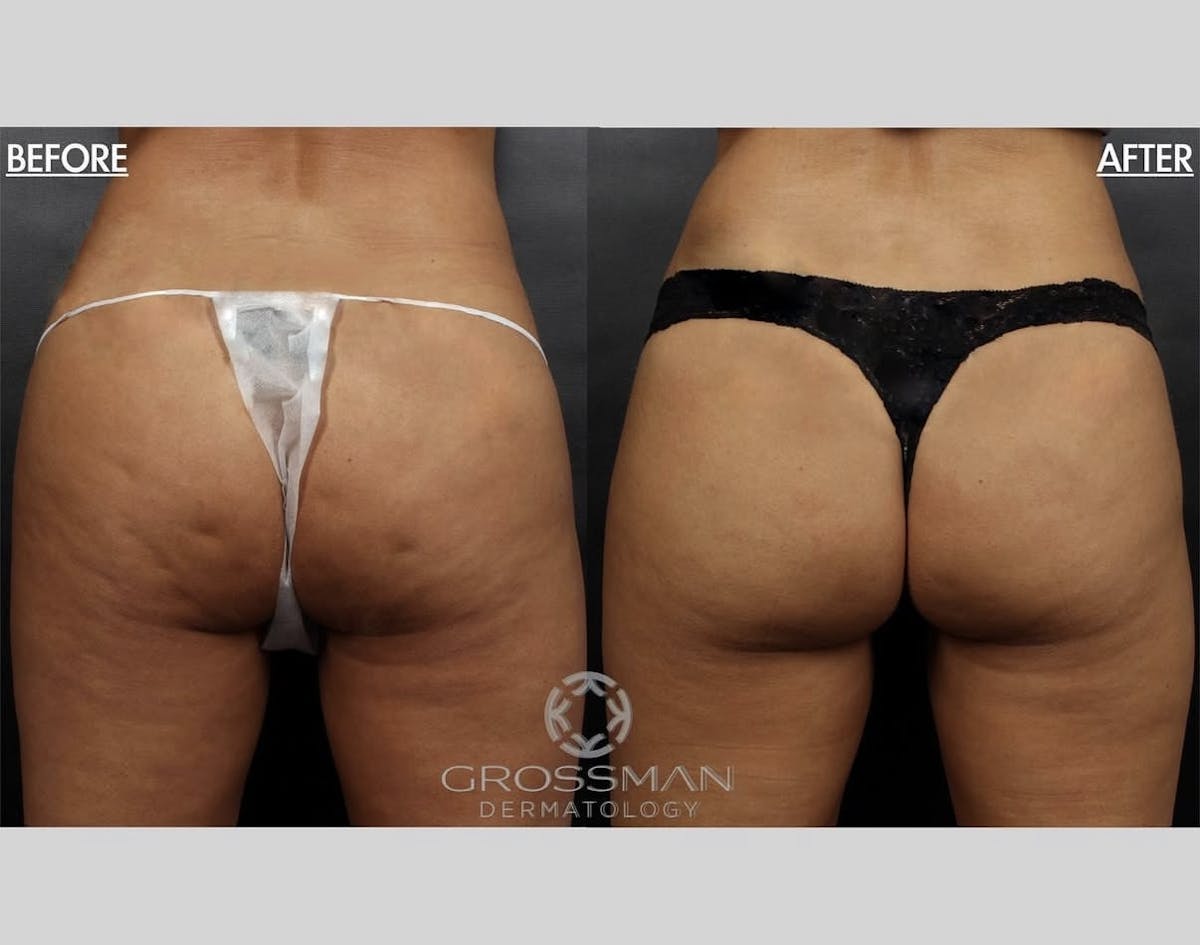 Non-Invasive Fat Reduction Before & After Gallery - Patient 187601 - Image 1