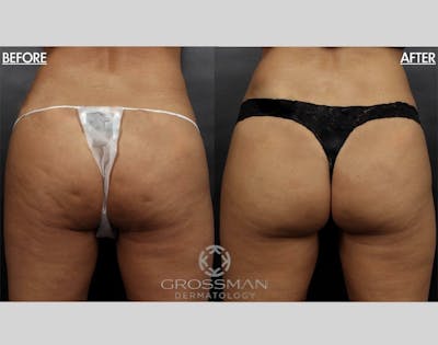 Non-Invasive Fat Reduction Before & After Gallery - Patient 187601 - Image 1