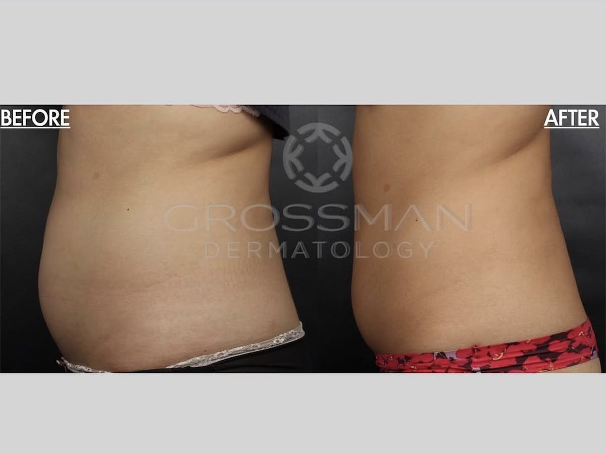 Non-Invasive Fat Reduction Before & After Gallery - Patient 648498 - Image 1