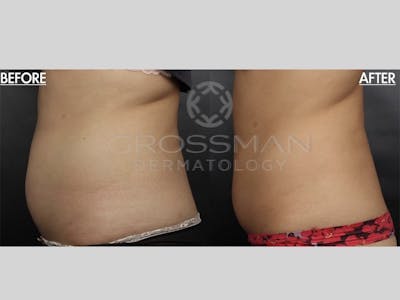 Non-Invasive Fat Reduction Before & After Gallery - Patient 648498 - Image 1