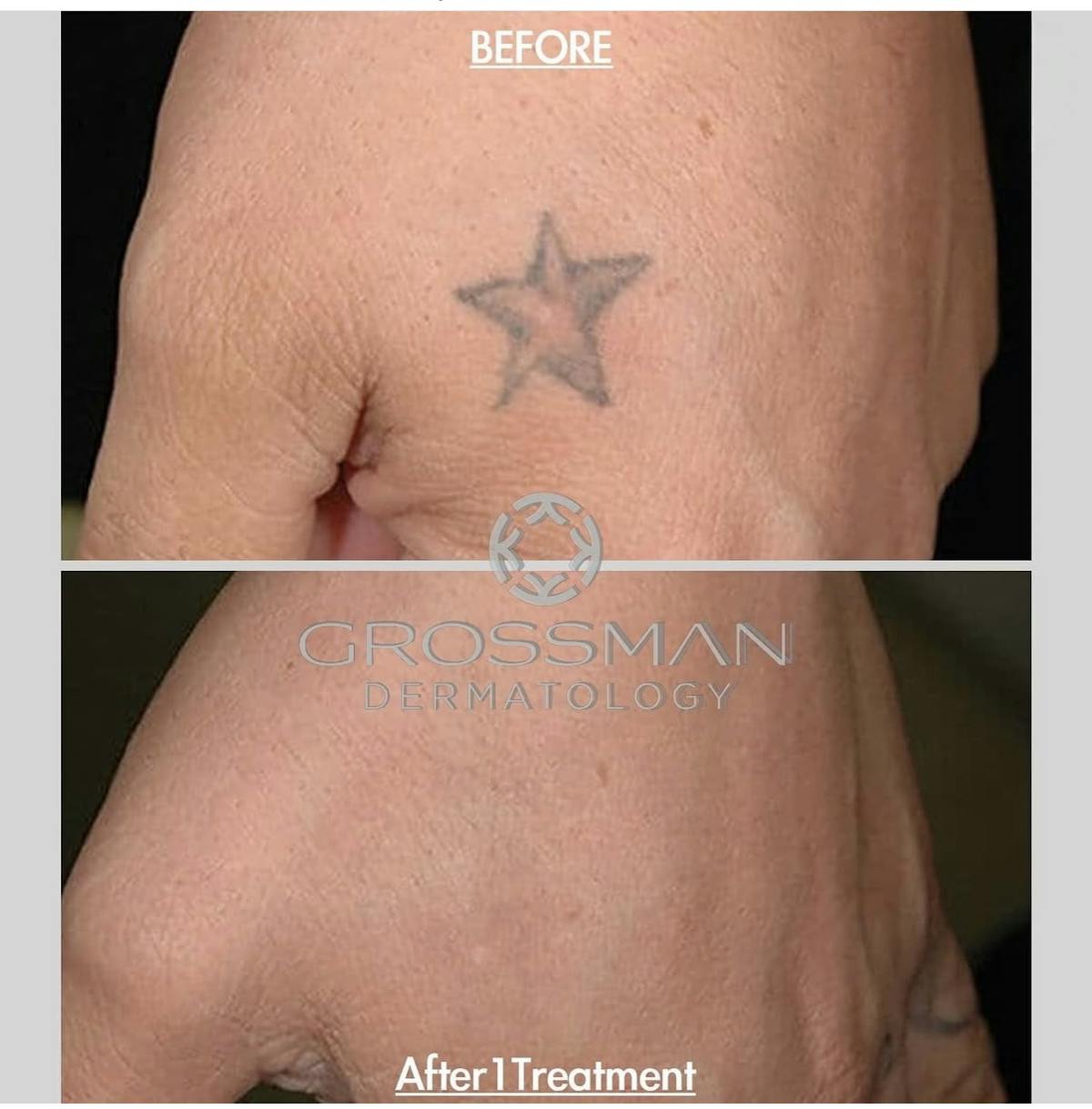 Laser Tattoo Removal Before & After Gallery - Patient 413900 - Image 1
