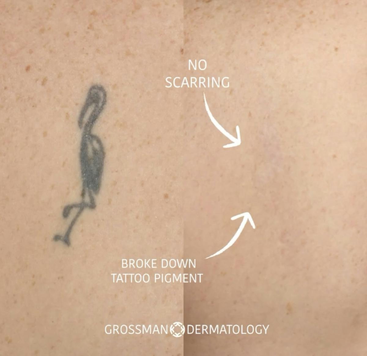 Laser Tattoo Removal Before & After Gallery - Patient 218468 - Image 1
