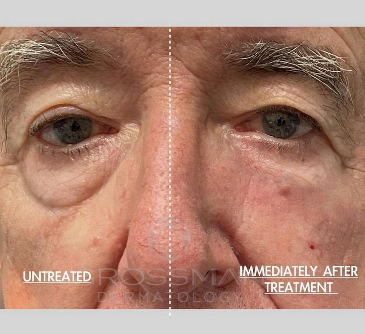 Fillers Before & After Gallery - Patient 135181 - Image 1