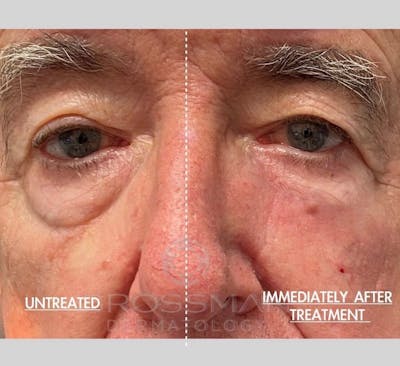 Eyes Before & After Gallery - Patient 932405 - Image 1