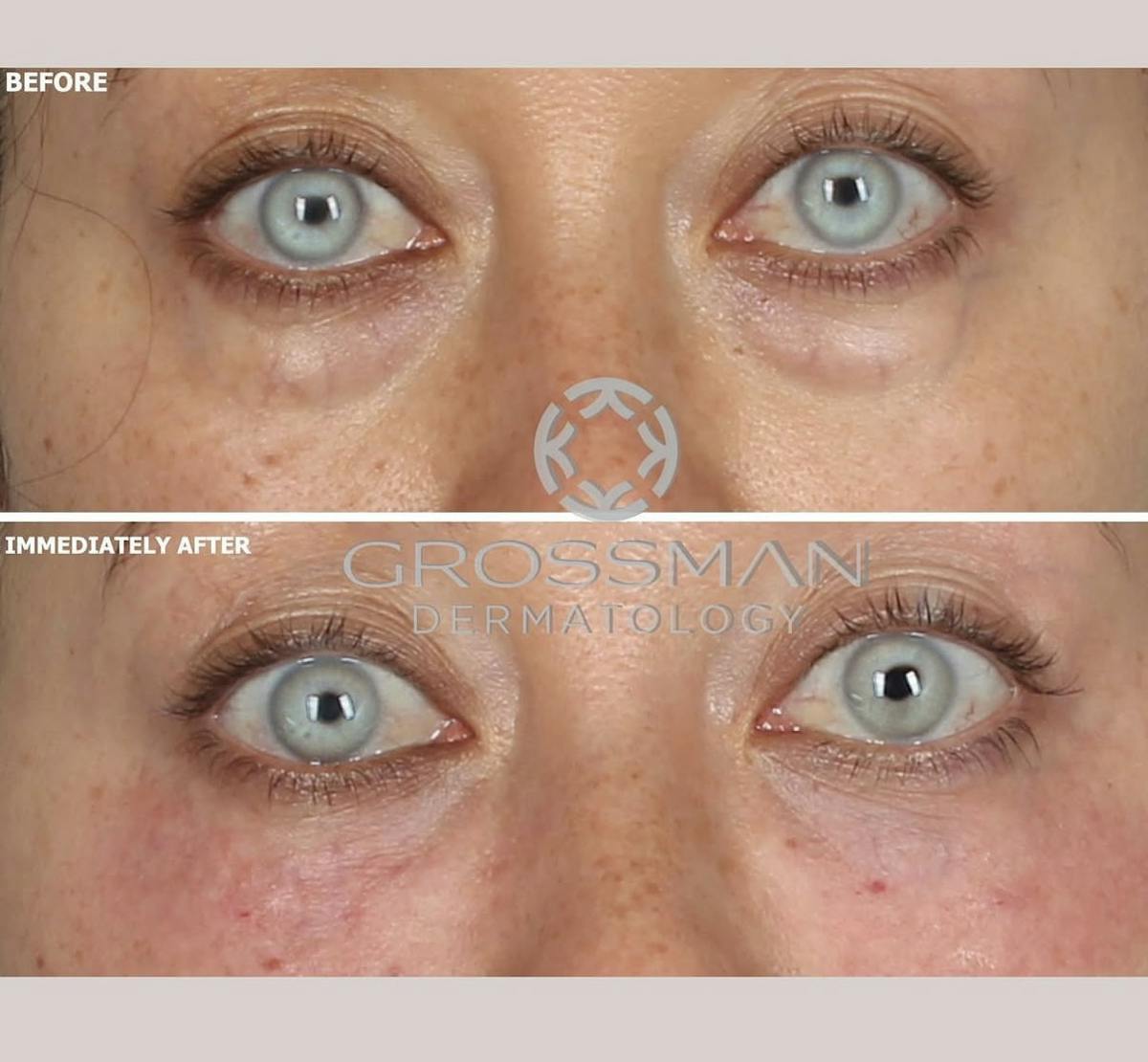 Fillers Before & After Gallery - Patient 127832 - Image 1