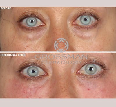 Eyes Before & After Gallery - Patient 341948 - Image 1