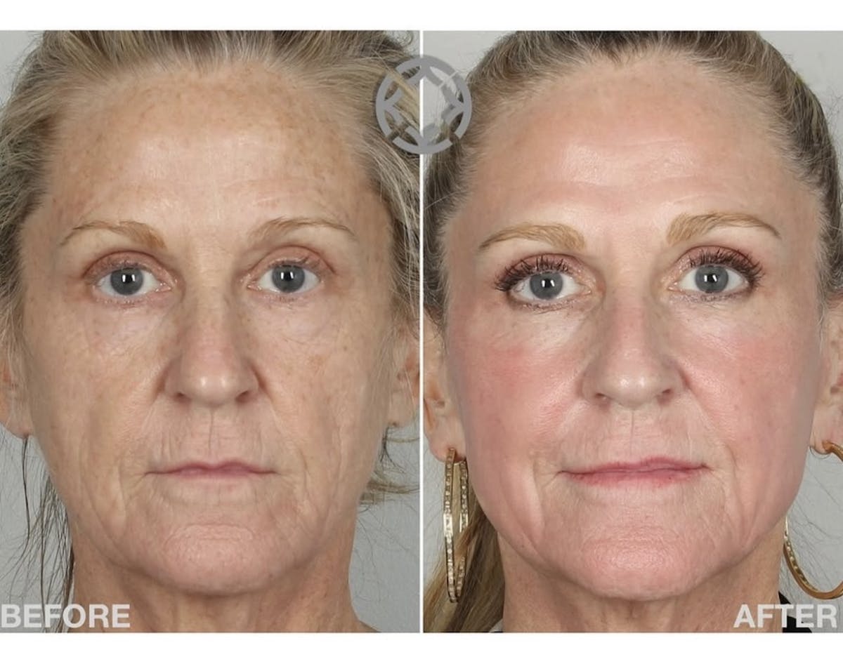 KustomeKarynKombo Before & After Gallery - Patient 147645 - Image 1