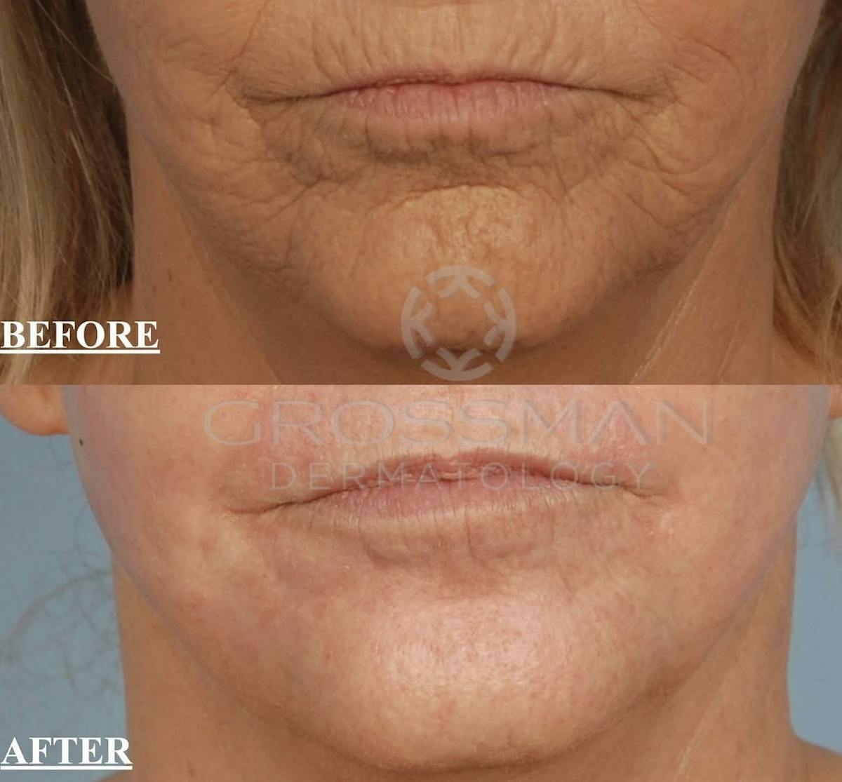 KustomeKarynKombo Before & After Gallery - Patient 570444 - Image 1