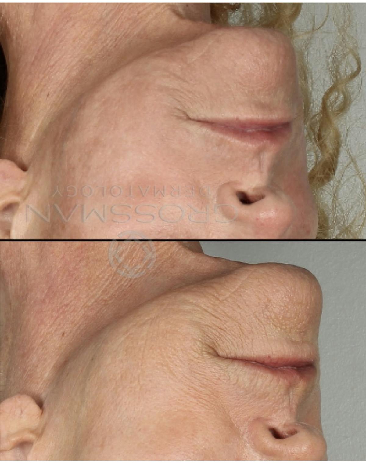 KustomeKarynKombo Before & After Gallery - Patient 424376 - Image 1