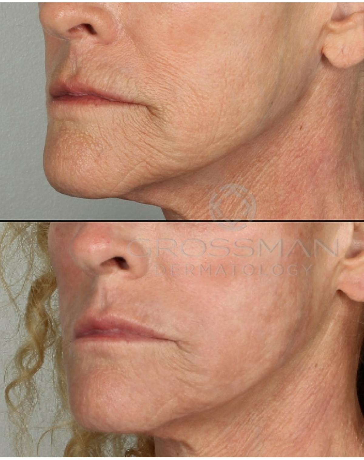 KustomKarynKombo Before & After Gallery - Patient 243395 - Image 1