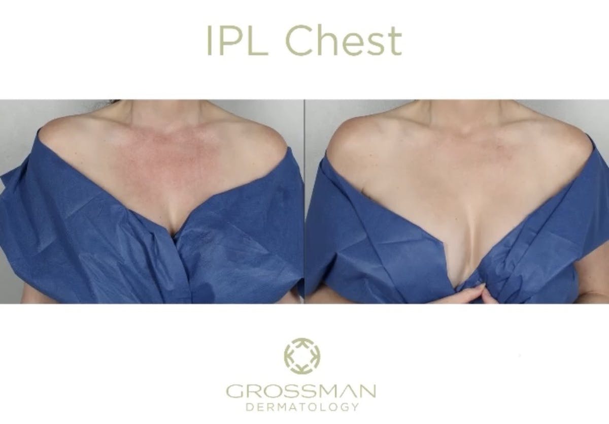 IPL Before & After Gallery - Patient 872835 - Image 1