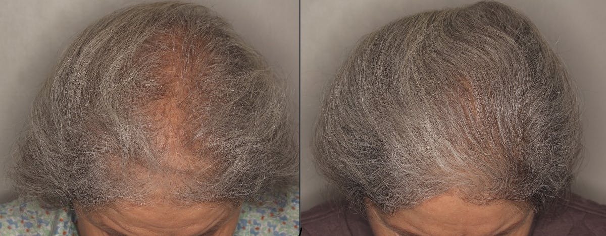 Hair Restoration Before & After Gallery - Patient 399392 - Image 1
