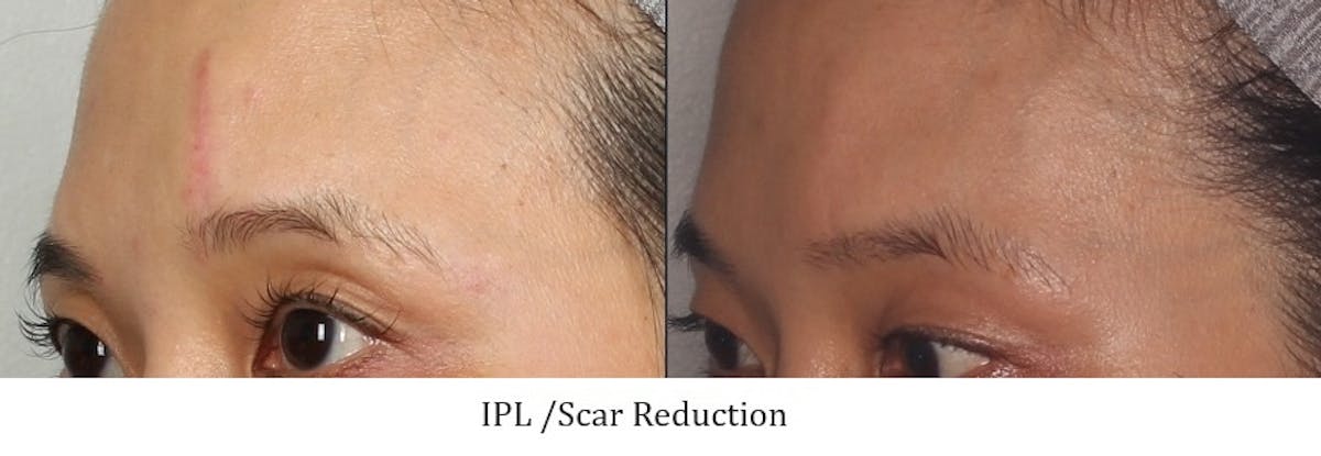 IPL Before & After Gallery - Patient 296176 - Image 1