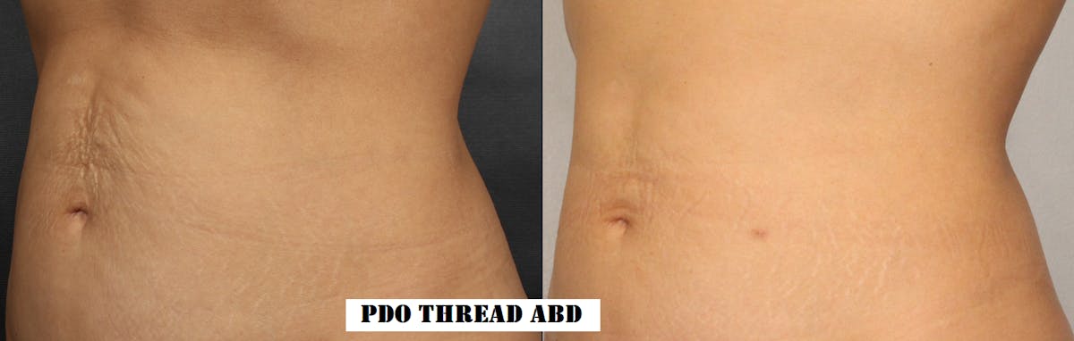 PDO Threads Before & After Gallery - Patient 356586 - Image 1