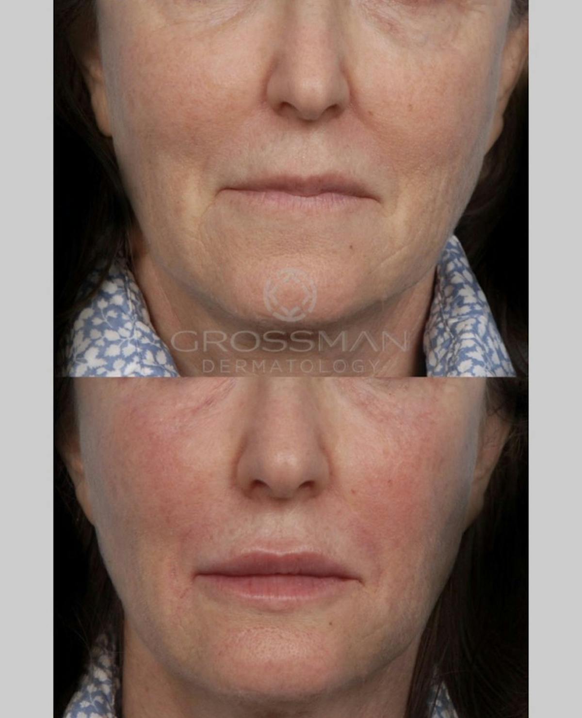 Eyes Before & After Gallery - Patient 761057 - Image 1