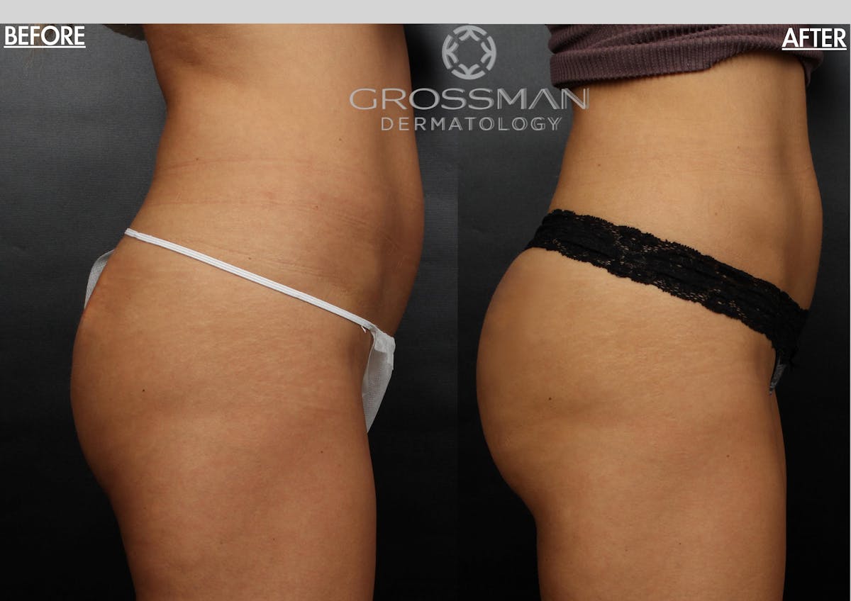 Sculptra - Buttocks / Hip Dips Before & After Gallery - Patient 390261 - Image 1