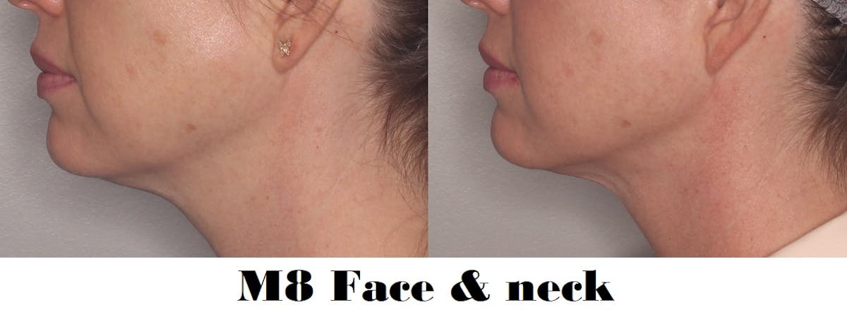 M8 / Morpheus8 / Potenza Before & After Gallery - Patient 279971 - Image 1