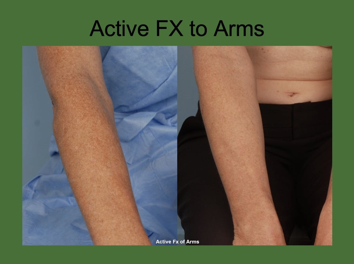 Fractionated Resurfacing Before & After Gallery - Patient 363728 - Image 1