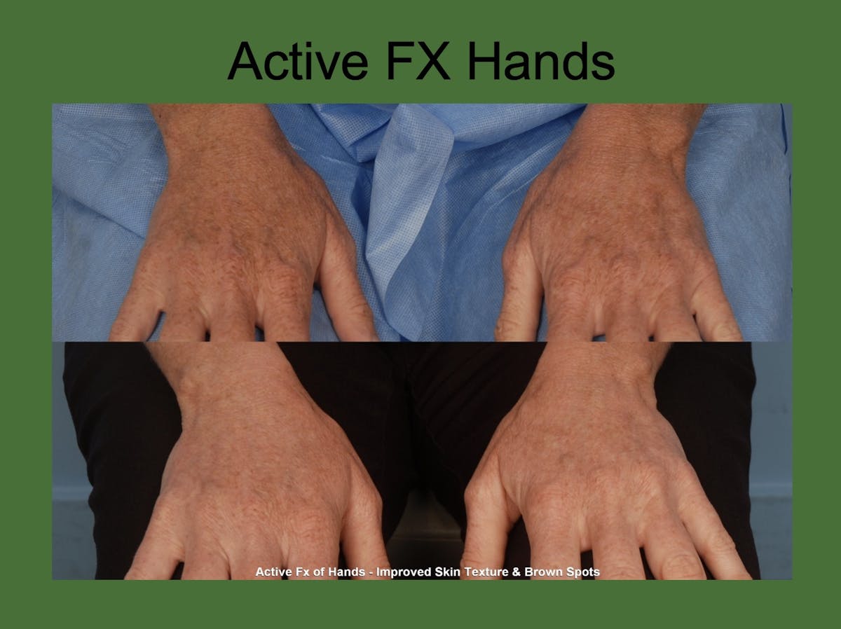 Fractionated Resurfacing Before & After Gallery - Patient 242759 - Image 1