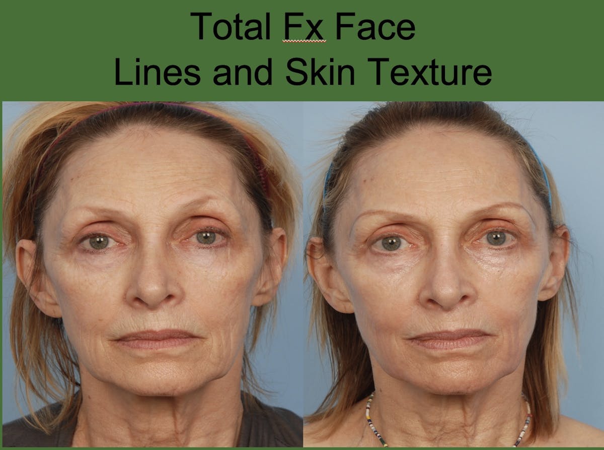 Fractionated Resurfacing Before & After Gallery - Patient 281766 - Image 1