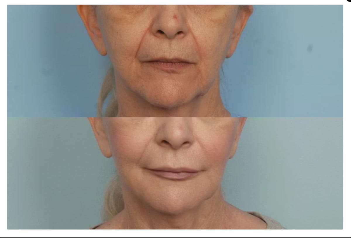 Fat / Micro Fat / Nano Fat Before & After Gallery - Patient 757411 - Image 1