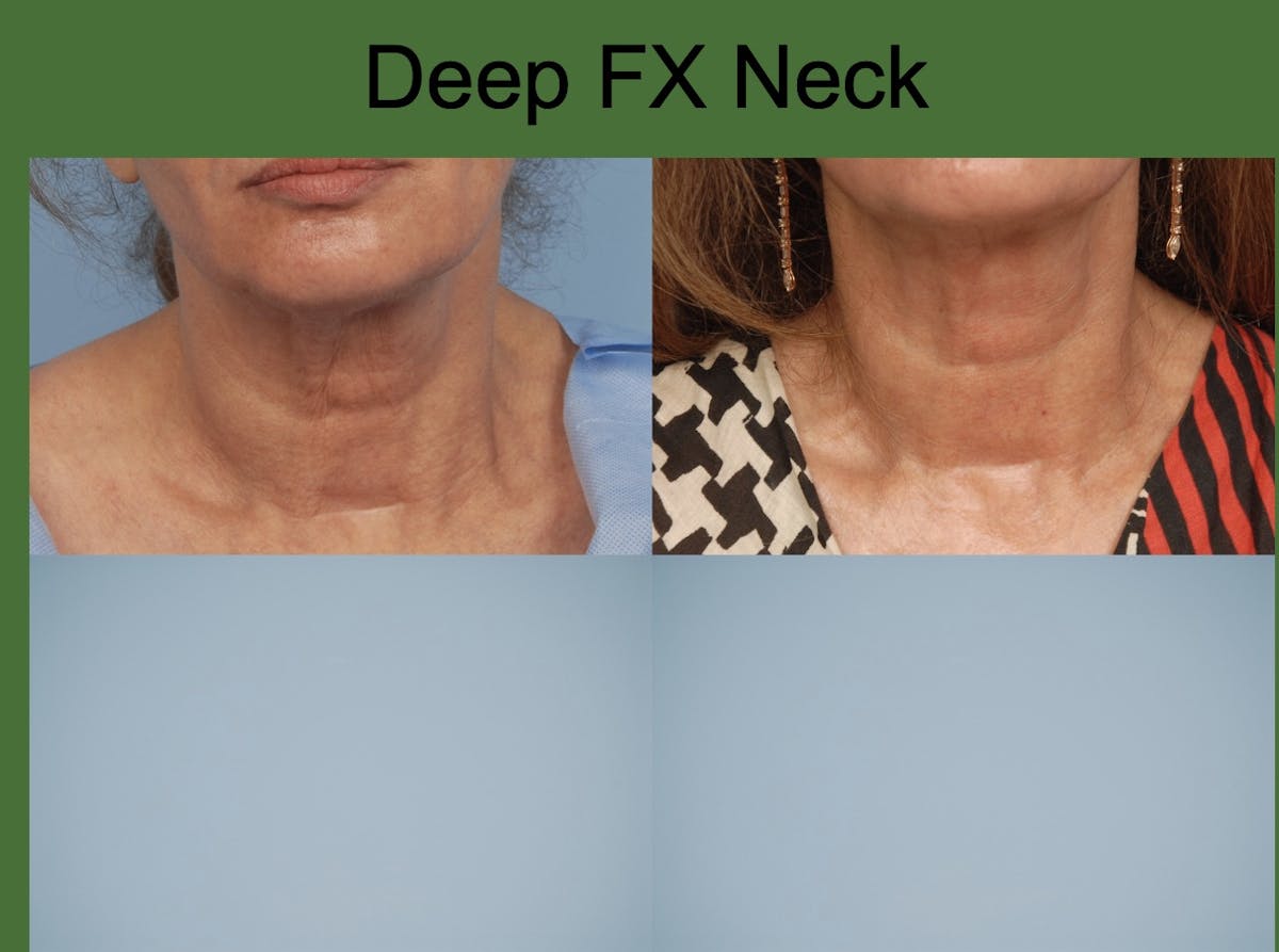 Fractionated Resurfacing Before & After Gallery - Patient 176064 - Image 1
