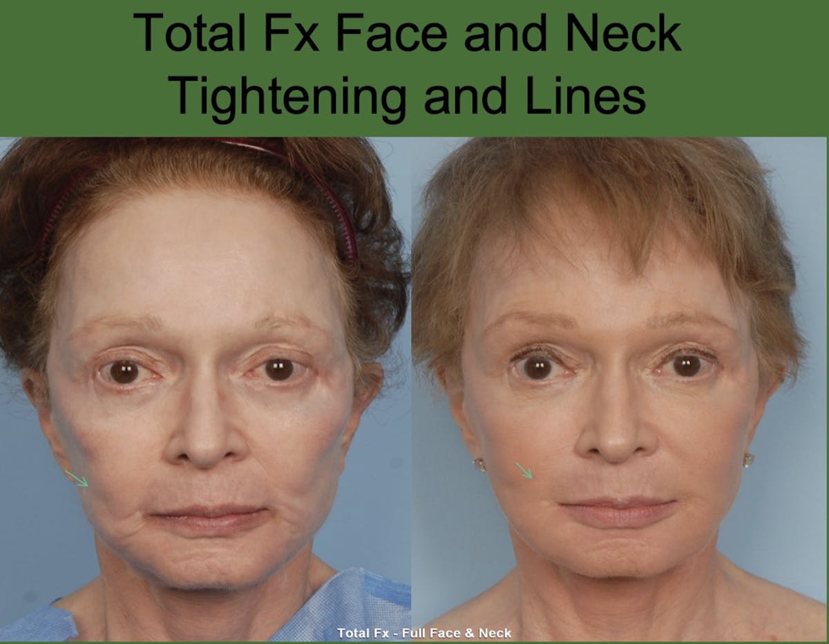 CO2 Laser Resurfacing Before & After Gallery - Patient 393281 - Image 1