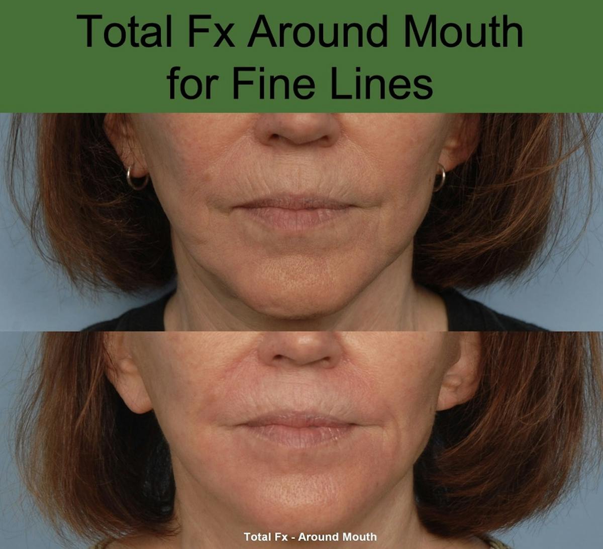 CO2 Laser Resurfacing Before & After Gallery - Patient 333677 - Image 1