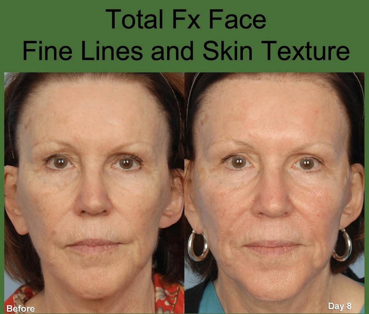 CO2 Laser Resurfacing Before & After Gallery - Patient 310096 - Image 1