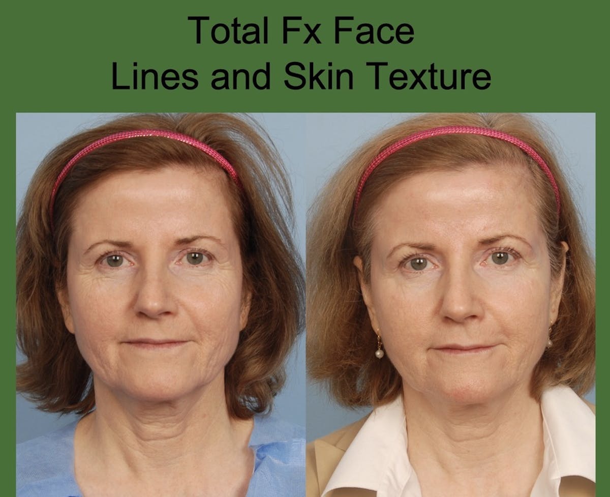 CO2 Laser Resurfacing Before & After Gallery - Patient 194871 - Image 1