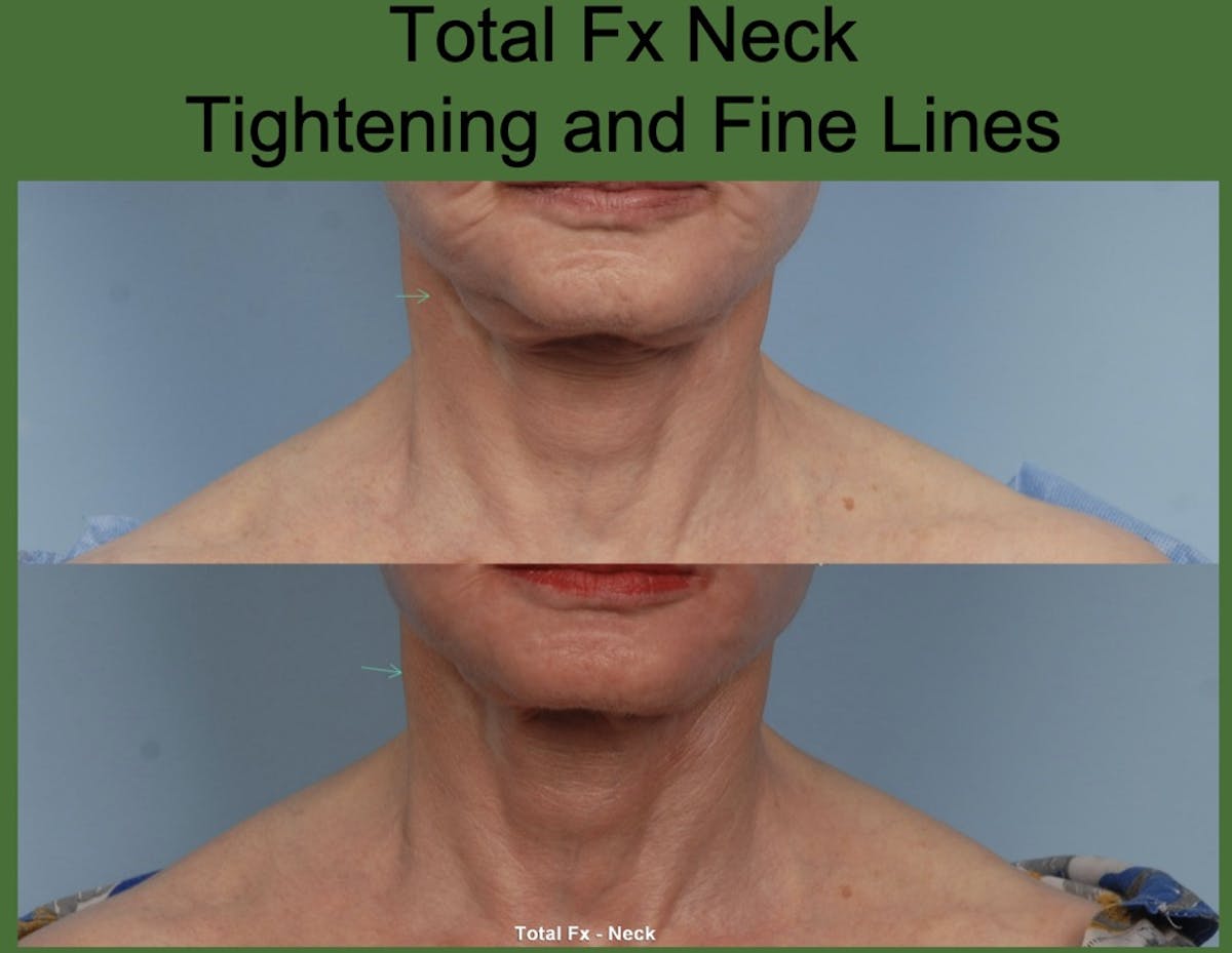 CO2 Laser Resurfacing Before & After Gallery - Patient 902551 - Image 1