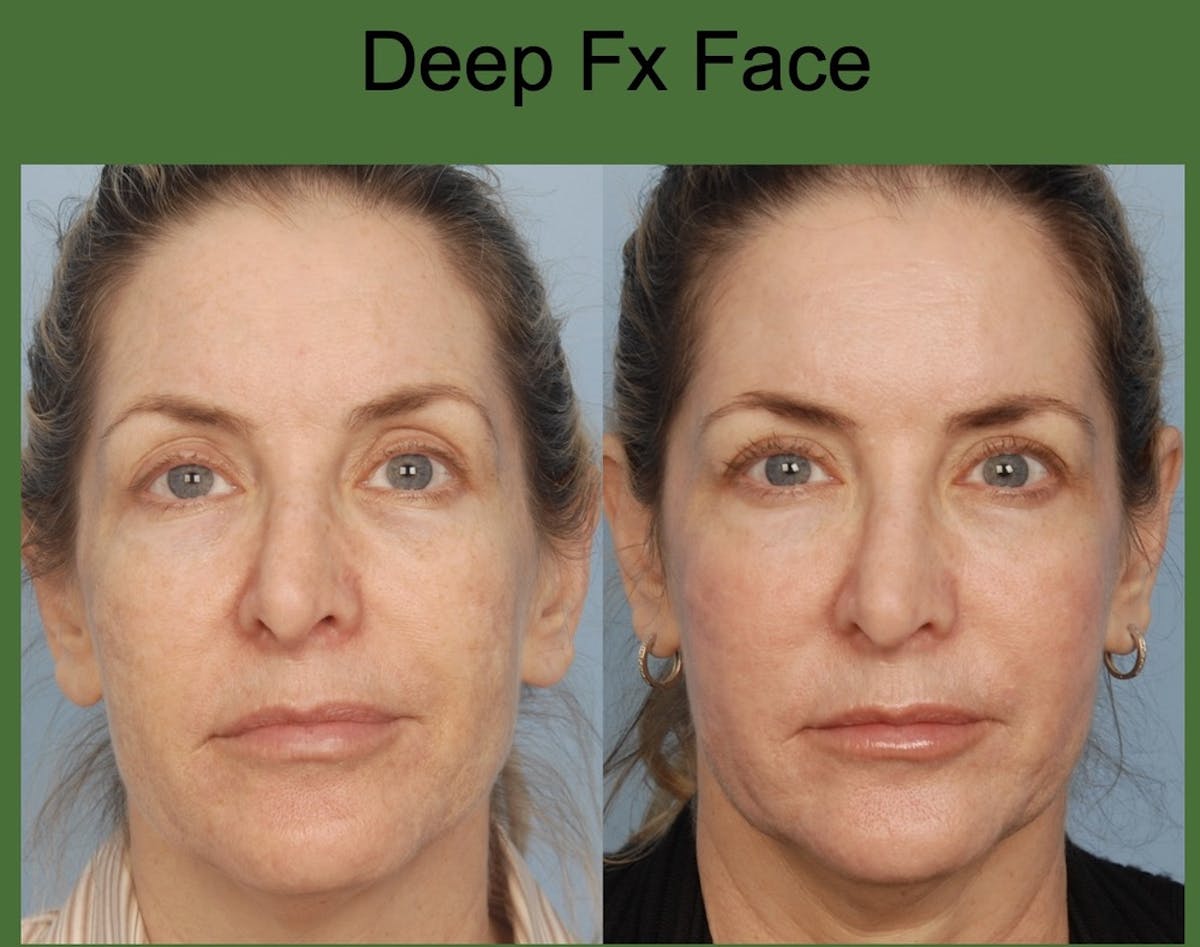 CO2 Laser Resurfacing Before & After Gallery - Patient 191882 - Image 1