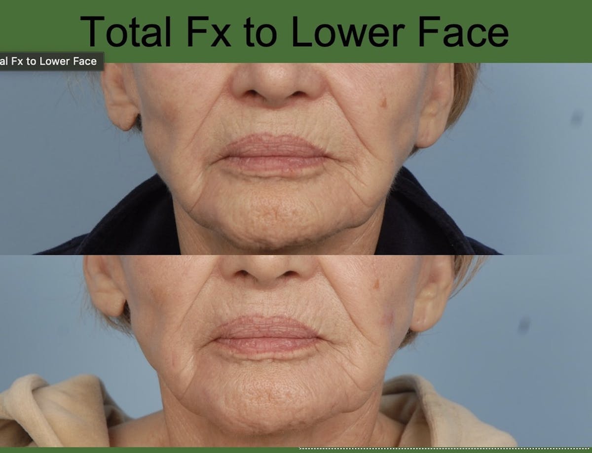 CO2 Laser Resurfacing Before & After Gallery - Patient 375558 - Image 1