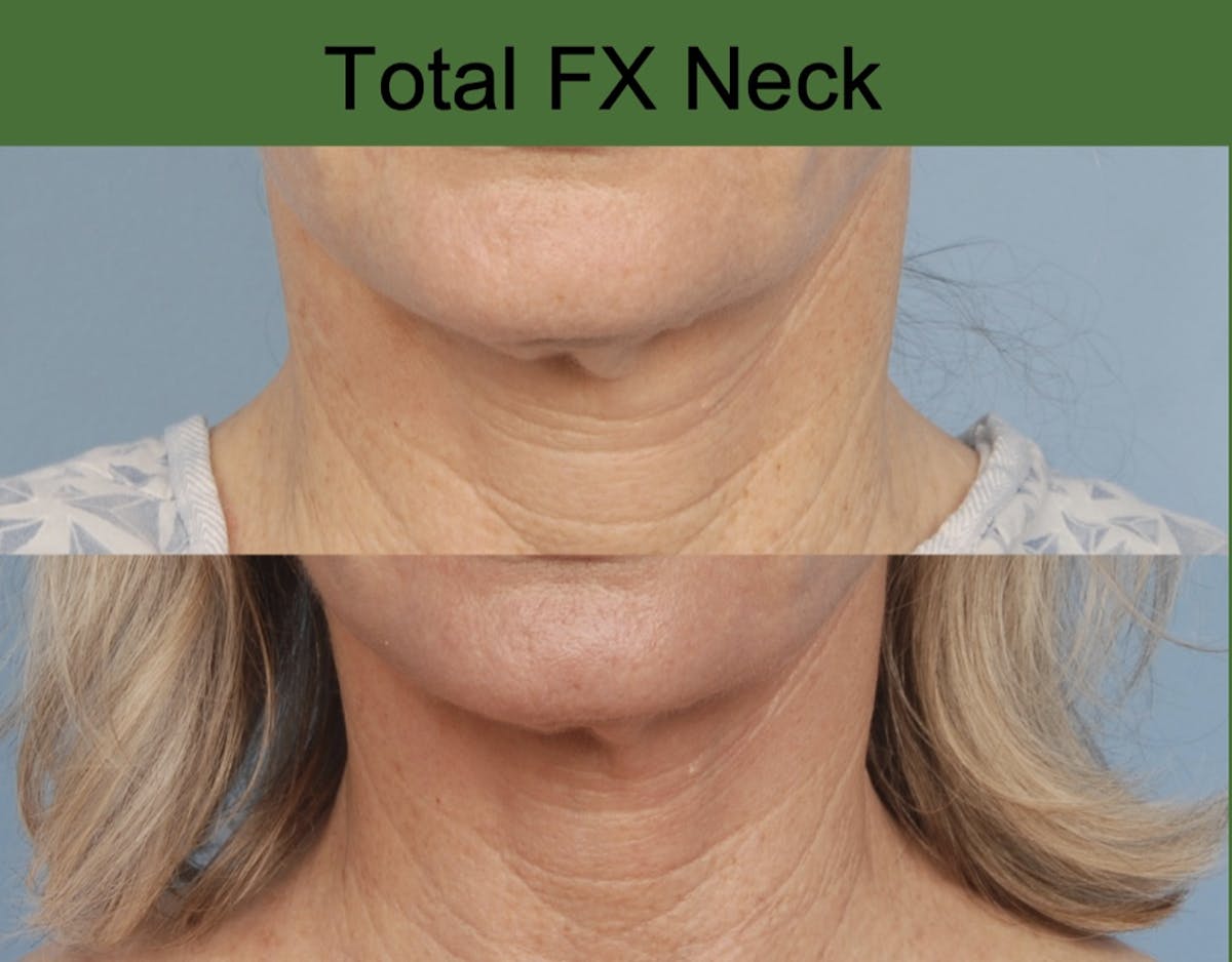 CO2 Laser Resurfacing Before & After Gallery - Patient 865477 - Image 1