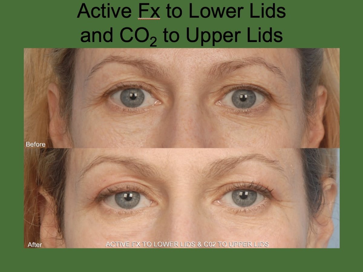 Fractionated Resurfacing Before & After Gallery - Patient 323628 - Image 1