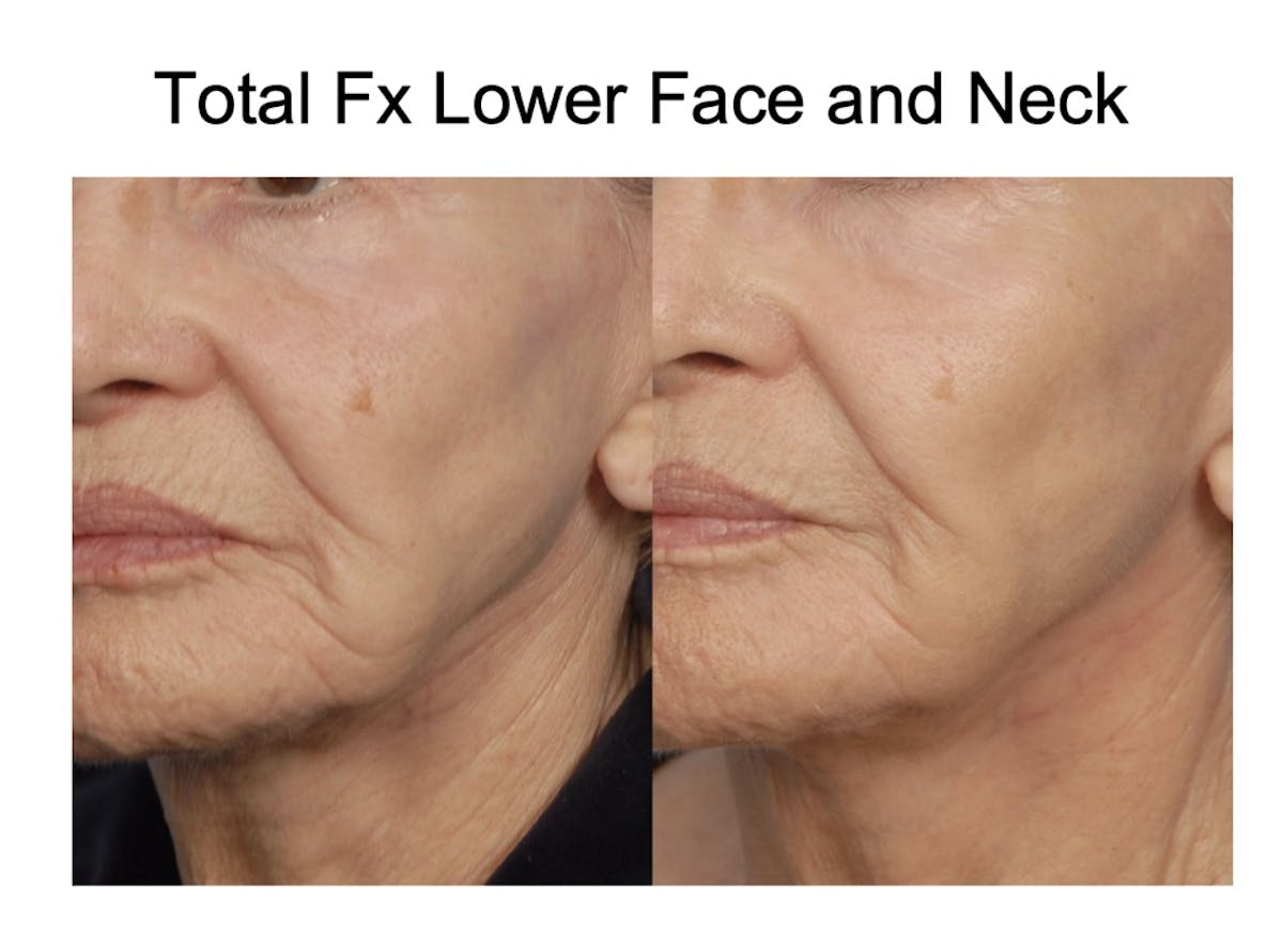 CO2 Laser Resurfacing Before & After Gallery - Patient 386585 - Image 1
