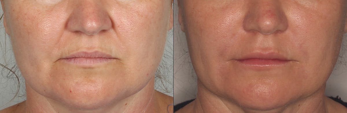 Lower Face Before & After Gallery - Patient 211412 - Image 1